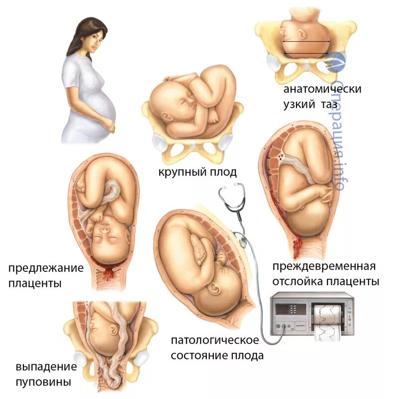 Как сделать рожу. Кесоро высечение. Керевасичение.