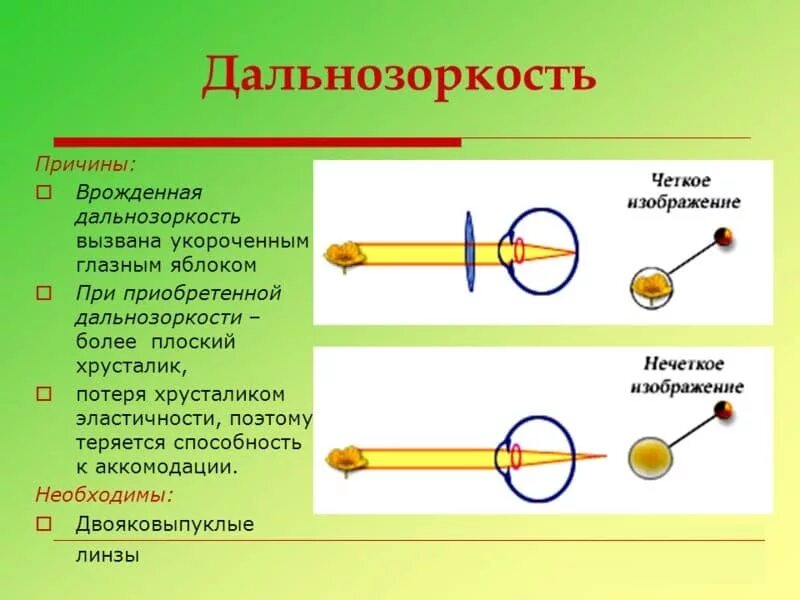 Какова причина развития близорукости у человека?. Близорукость причины возникновения. Анатомо физиологические причины близорукости это. Дальнозоркость причины возникновения. Анатомо физиологические причины близорукости это.