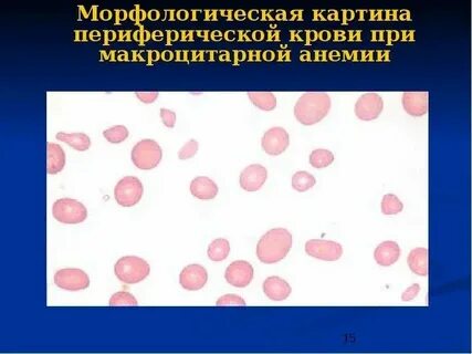 Анизоцитоз это в анализе