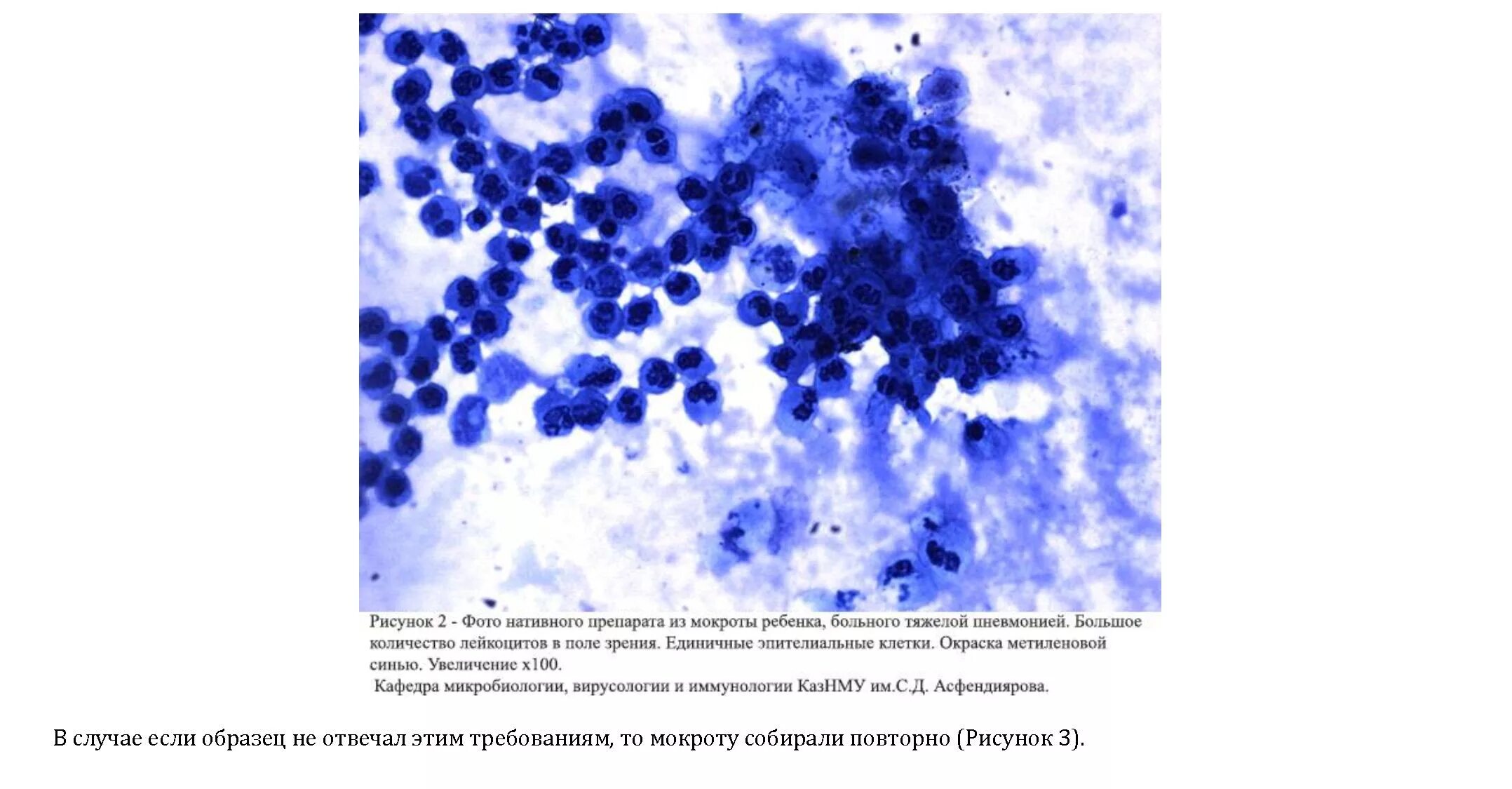 Элементы мокроты. Микроскопия мазков мокроты. Лейкоциты в мокроте микроскопия. Мокрота микроскопия окрашенного мазка. Микроскопия мокроты атлас.