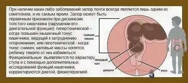 Кровь после опорожнения кишечника. Запор твердый кал с кровью. Кровь в Кале у ребенка при запоре. Кровь при затрудненной дефекации.