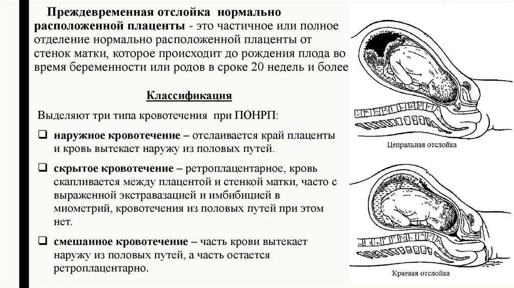 Отслойка хориона на ранних сроках. Ретроплацентарная отслойка плаценты. Отслойка нормально расположенной плаценты симптомы. Преждевременная отслойка плаценты симптомы. Осложнения при отслойке плаценты.