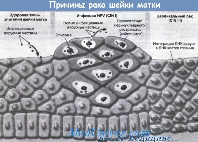 Вирус рака шейки матки. Койлоцитоз эпителия. Койлоцитоз шейки матки гистология. Койлоциты в гистологии шейки. Вирус папилломы шейки матки.