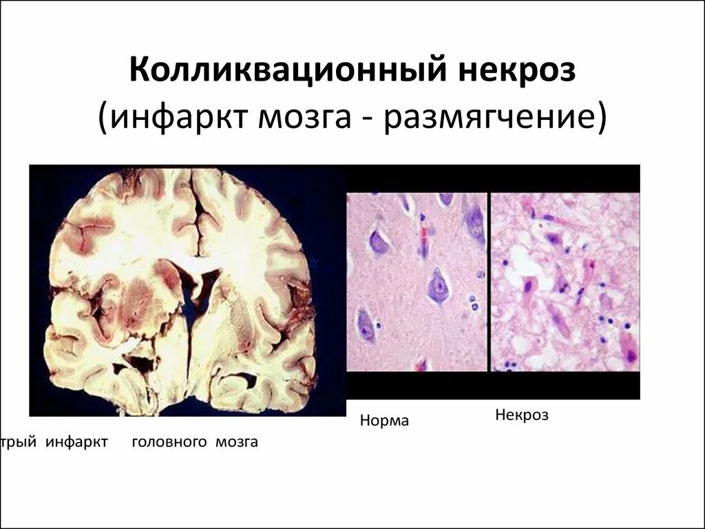 Колликвационный некроз это. Колликвационный некроз гистология. фокальный колликвационный некроз клетки.