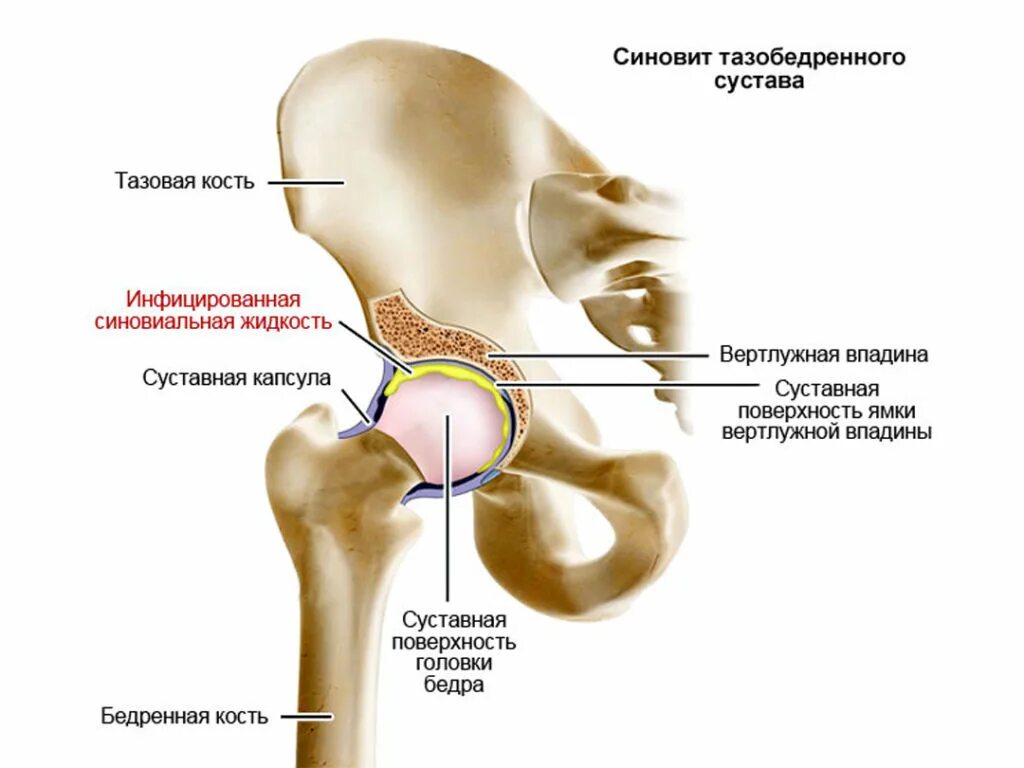 Как лечить синовит тазобедренного. Вертлужная впадина тазобедренного сустава. синовит тазобедренного сустава сустава. двусторонний синовит тазобедренного сустава. анатомия вертлужной впадины тазобедренного сустава.