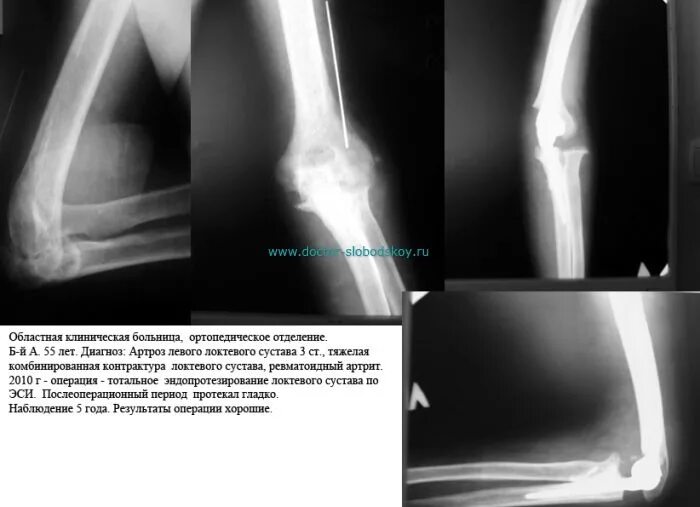 Посттравматический контрактура сустава. Синовит локтевого сустава рентген. Эндопротез локтевого сустава рентген. Деформирующий артроз локтевого сустава рентген. Посттравматический артроз локтевого сустава рентген.