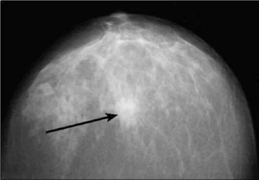 Фиброзно склеротические изменения. Узловая мастопатия молочной железы маммография. Фибролипома молочной железы рентген. Фиброзная мастопатия маммограмма. Фиброаденома молочной железы маммограмма.