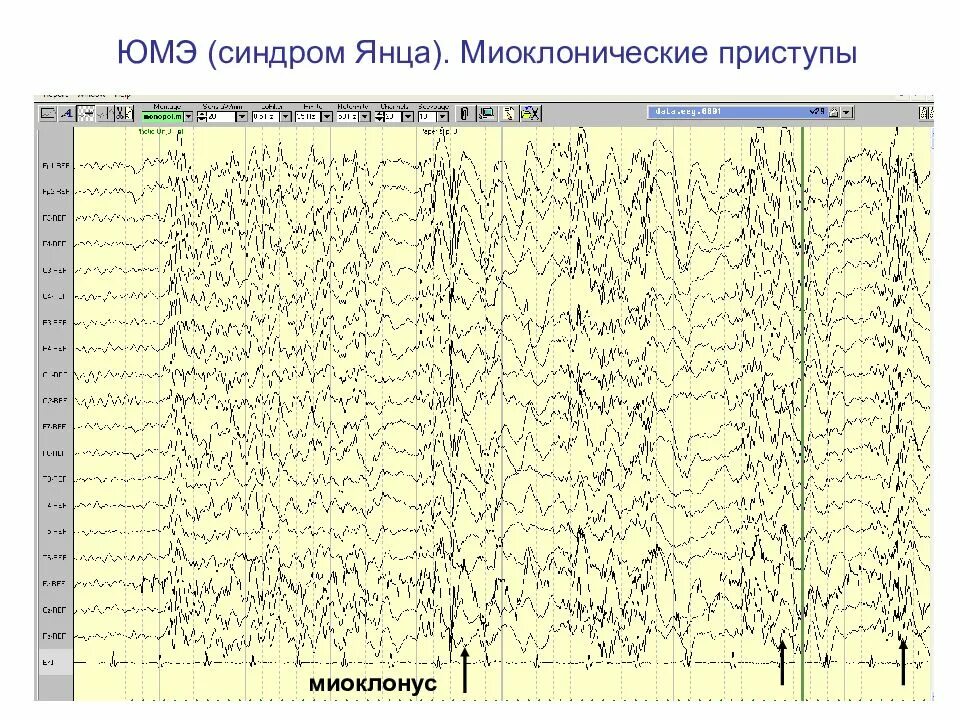 Миоклоническая эпилепсия ЭЭГ. Ювенильная миоклоническая эпилепсия ЭЭГ. Миоклонический приступ на ЭЭГ. ЭЭГ при юношеской миоклонической эпилепсии. Юношеская эпилепсия