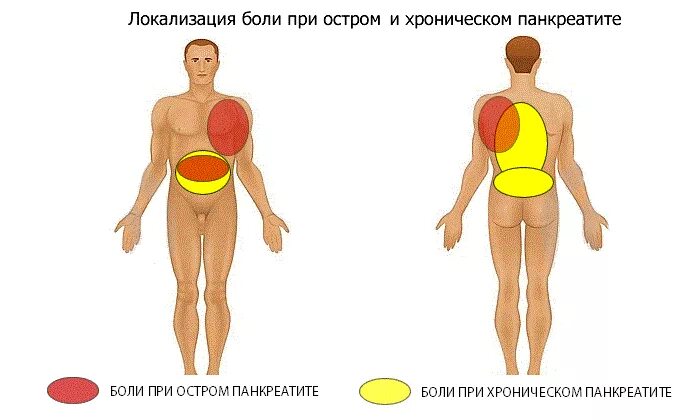 Поджелудочная боль в спине. Иррадиация боли при остром панкреатите. Локализация боли при остром панкреатите. Локализация ьоливспине. Болит спина.