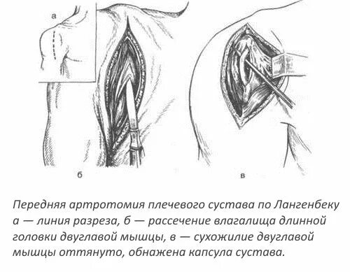 Артротомия плечевого сустава. Артротомия локтевого сустава по Лангенбеку. Артротомия коленного сустава по Лангенбеку. Пункции, артротомия и резекция плечевого сустава.. Задняя артротомия плечевого сустава.