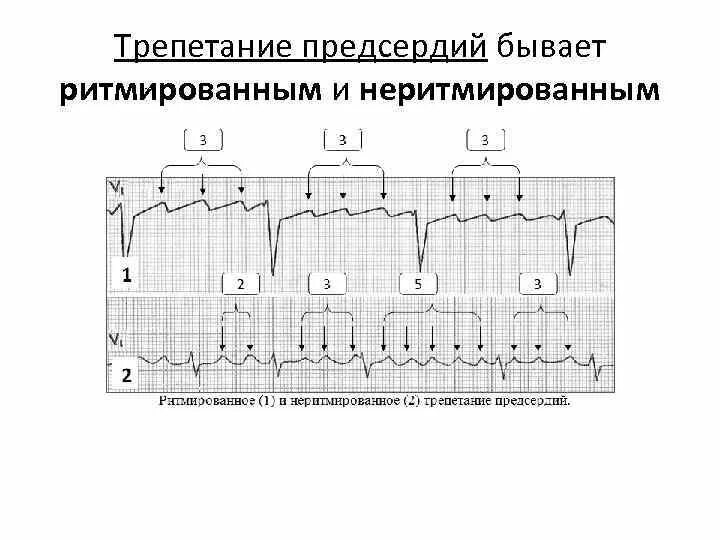 Трепетание предсердий 1 к 1 на ЭКГ. Трепетание предсердий на ЭКГ признаки. Трепетание предсердий 2 к 1 на ЭКГ. Правильная форма трепетания предсердий на ЭКГ. Формы трепетания предсердий