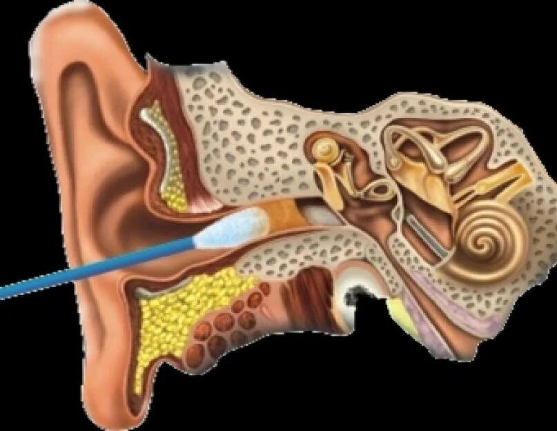 Как прочистить серную пробку. Ушная сера в барабанной перепонке. Отомикоз серная пробка. Серная пробка ушная палочка. Серная пробка за барабанной перепонкой.