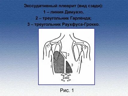 Экссудативный плеврит задачи