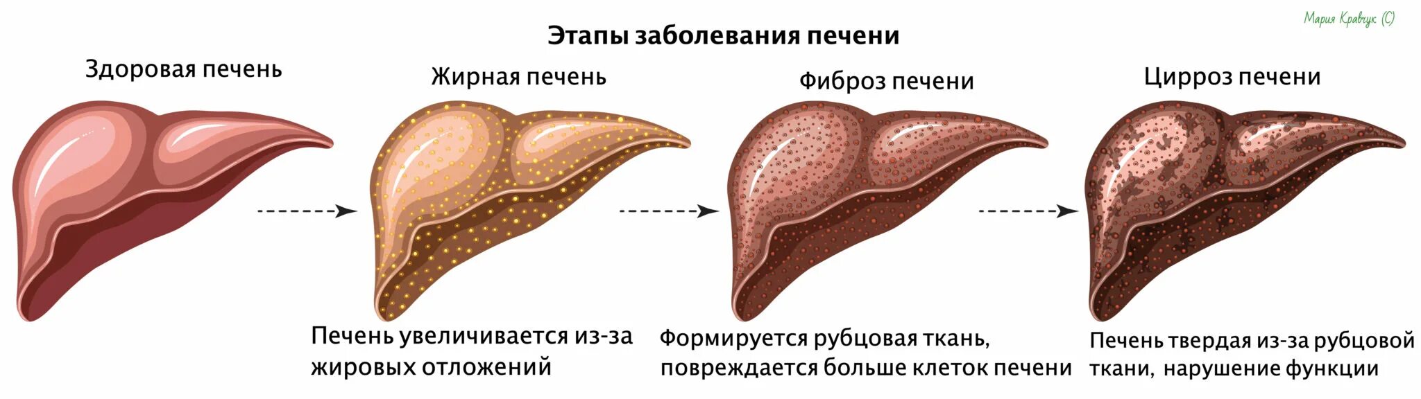 Печень плотная увеличенная. Жировое Перерождение печени, цирроз печени. Жировой гепатоз фиброз цирроз. Гепатоз печени на вскрытии. Фиброз печени макропрепарат.