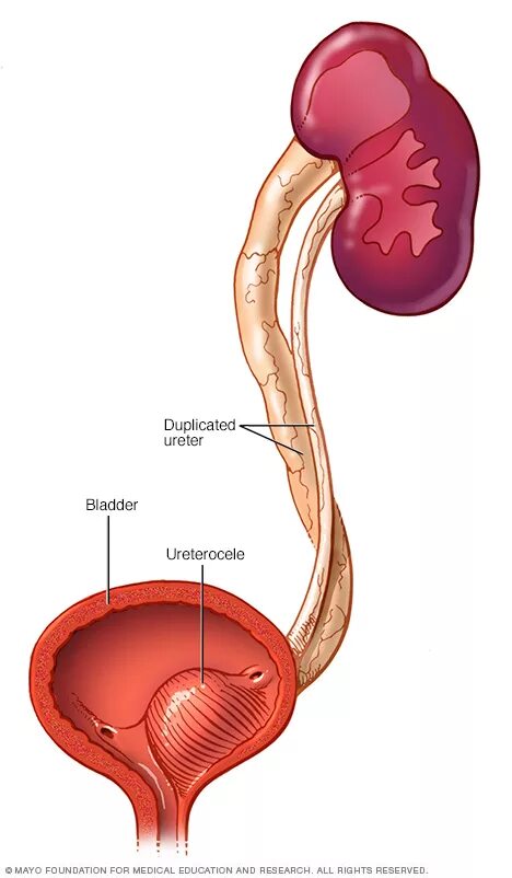 Уретероцеле мочевого пузыря. Устье мочеточника в мочевом пузыре. Уретероцеле мочеточника и камни. Ортотопическое уретероцеле. Обоих мочеточников