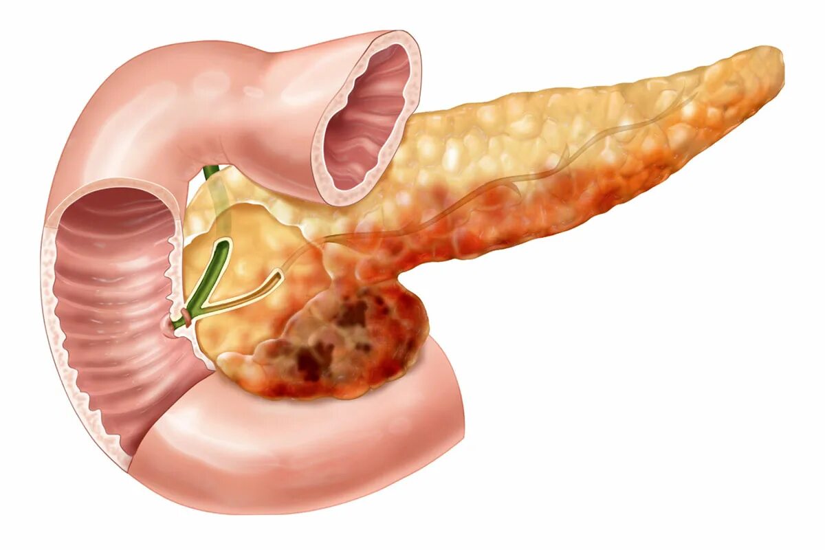 Некротический панкреонекроз поджелудочной железы. Здоровая поджелудочная железа макропрепарат. Острый панкреатит поджелудочной железы. Жировой панкреонекроз поджелудочной железы.