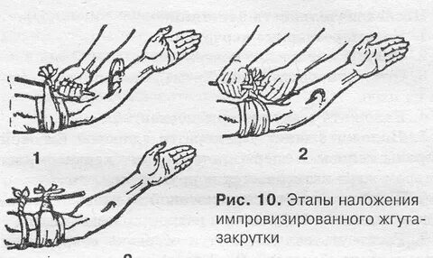 Жгут закрутка наложение