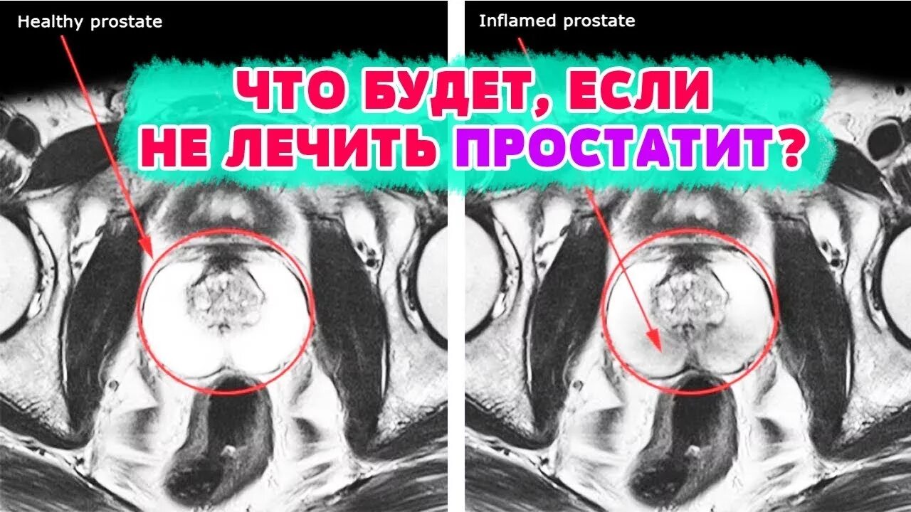 Простата действий. Последствия нелеченного простатита.