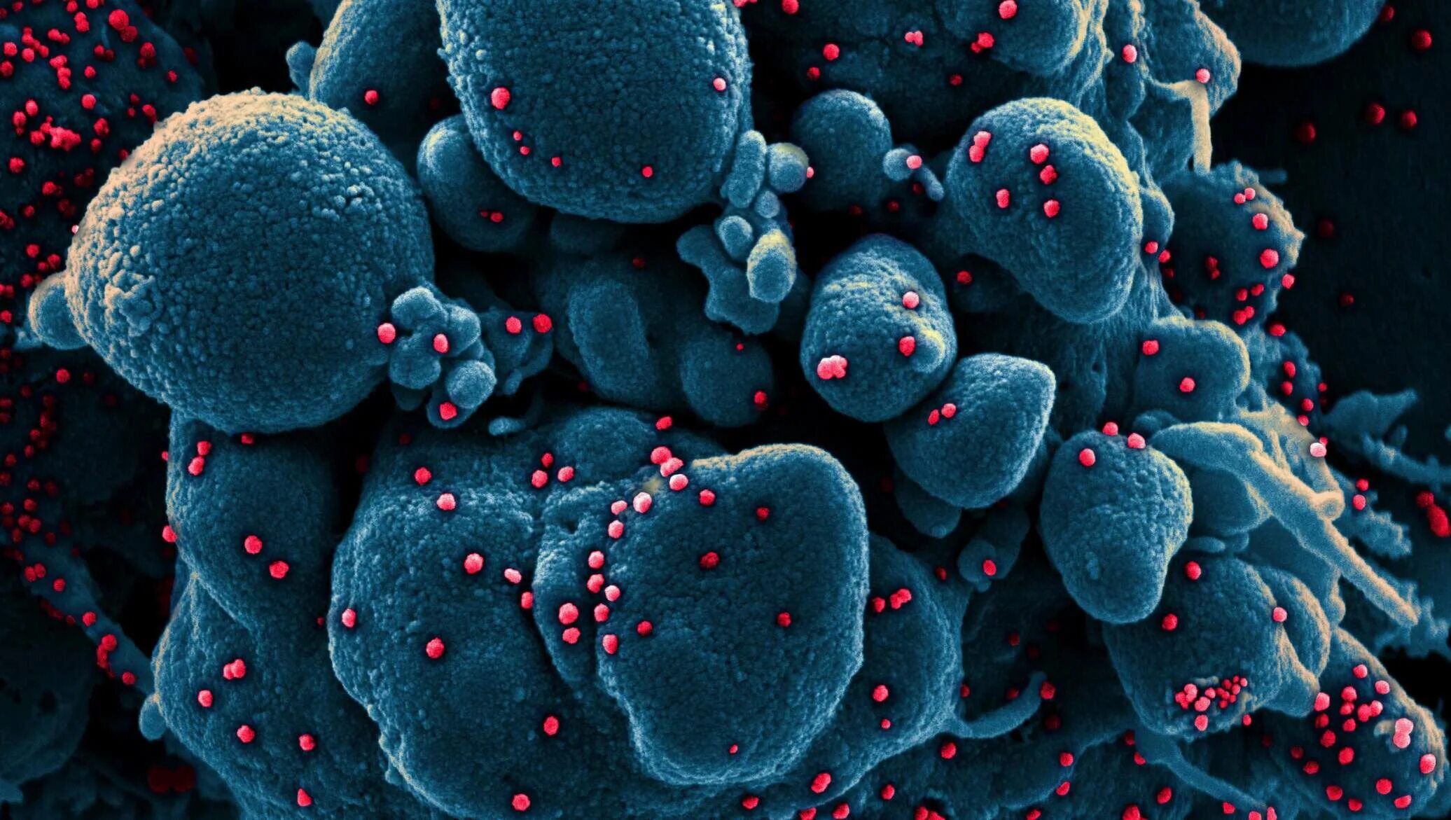 Атакующие клетки. SARS cov 19 под микроскопом. Вирус ковид 19 под микроскопом. Вирус коронавирус под микроскопом. Бактерия коронавируса под микроскопом.