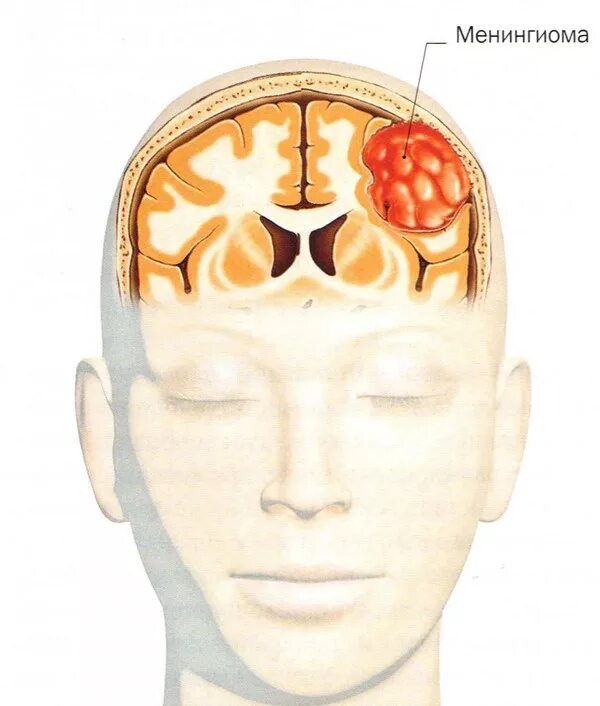 Менингиома кости черепа. Менингиома доброкачественная. Менингиома головного опухоль. Опухоль головного мозга отек