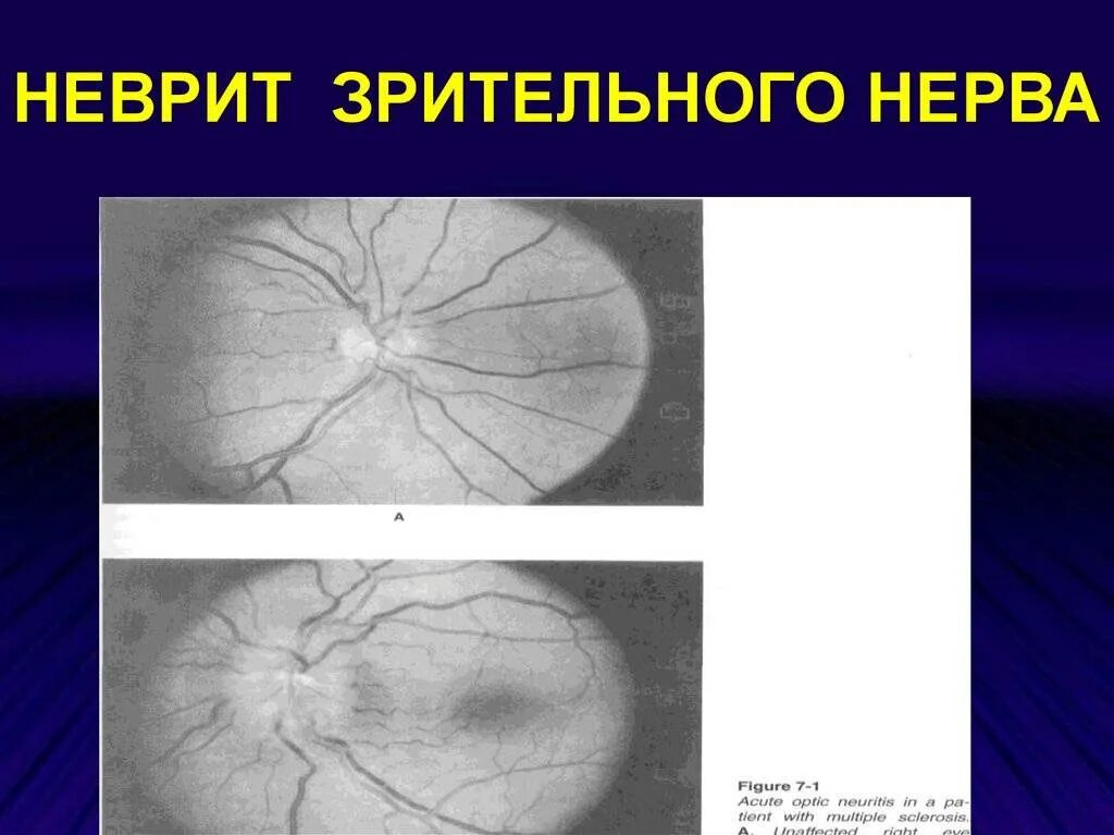 Оптический неврит папиллит. Рассеянный ретробульбарный неврит. H46 неврит зрительного нерва.. Рассеянный склероз неврит зрительного нерва.