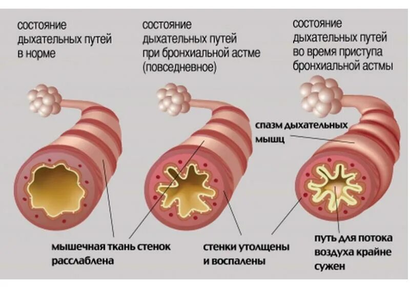 Бронхиальная астма вне приступа