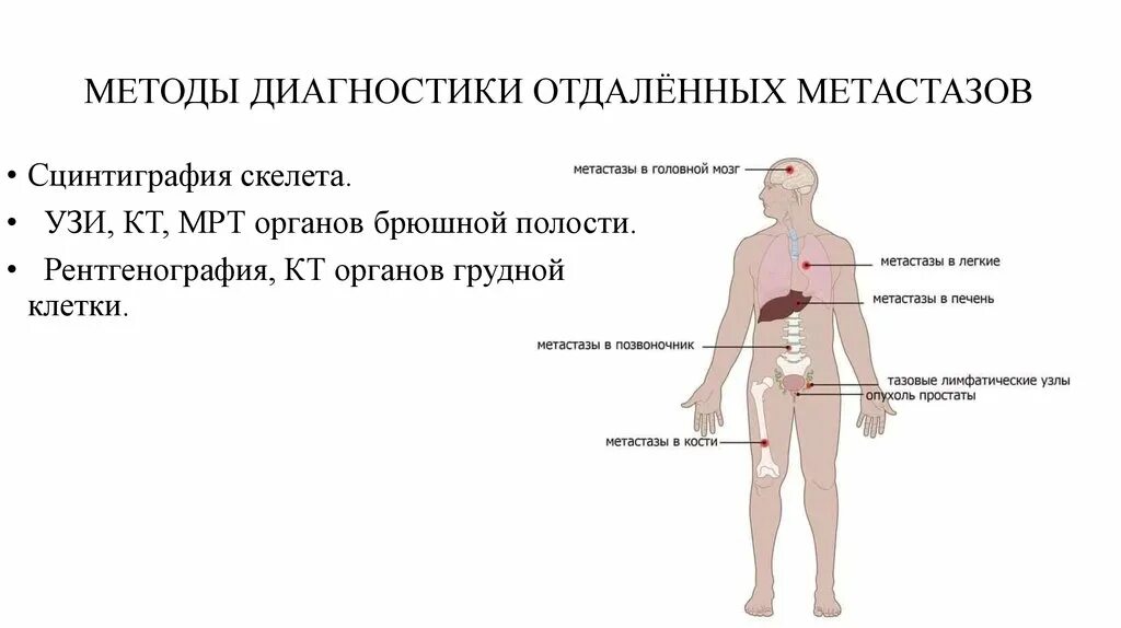 Отдаленные метастазы при раке. Методы диагностики метастазов. Метастазы в кости у мужчин. Метастазы предстательной железы.