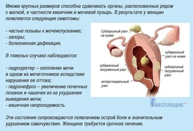 Миома матки симптомы и признаки. Клинические проявления миомы матки. Симптомы миомы матки у женщин.