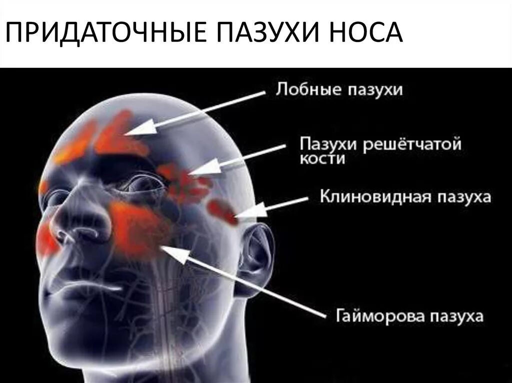 Клетки решетчатого лабиринта. Пазухи носа анатомия гайморит. Околоносовые придаточные пазухи. Носовые пазухи 3д модель. Гайморит фронтит этмоидит сфеноидит.