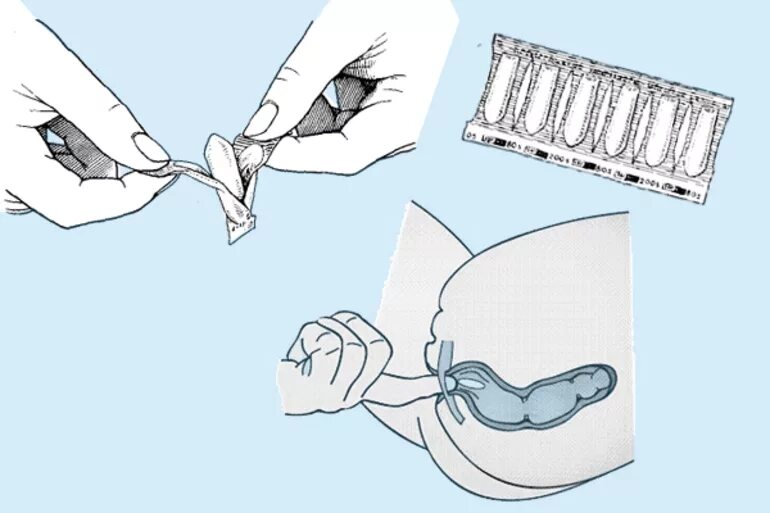Как вставить свечку ректально. Введение ректального суппозитория. Как правильно вставлять свечи ректально. Как вводить суппозитории ректальные.