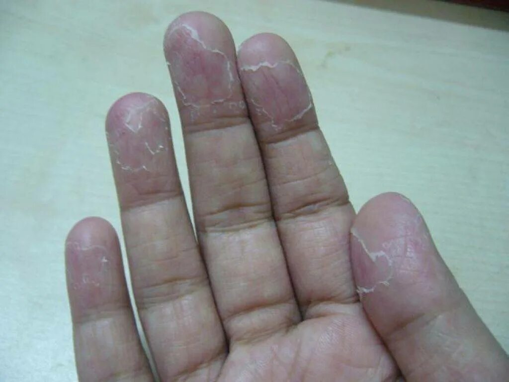 Почему шершавые руки. Шелушение кожи на пальцах рук.