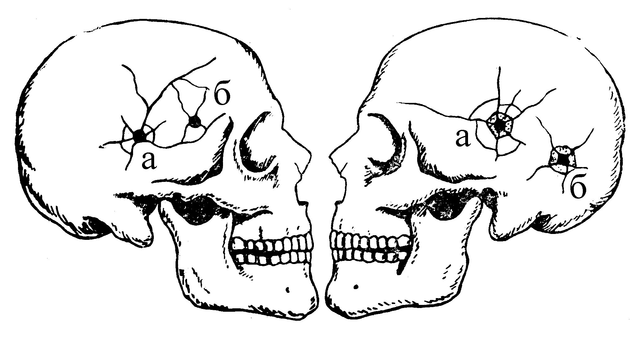 Череп разрыв. Дырчатый перелом костей черепа. Дырчатый перелом кости черепа. Дырчатые переломы переломы черепа. ЧМТ повреждения костей черепа.