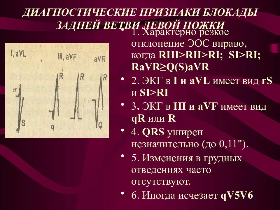 Блокада левой задней ножки. Блокада задней ветви ЛНПГ на ЭКГ. Блокада задней ветви левой ножки пучка Гиса на ЭКГ. Блокада задней ветви левой ножки на ЭКГ. Блокада левой задней.