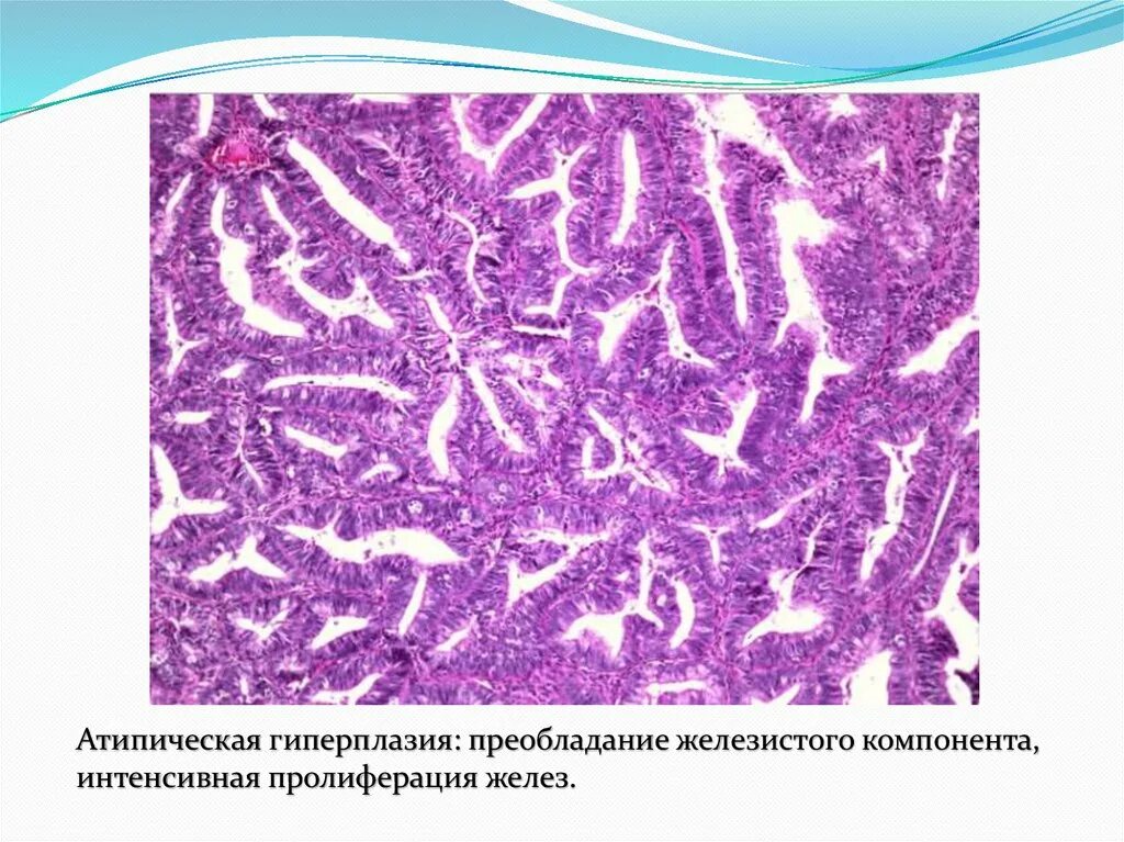 Железистая гиперплазия гистология. Железистая гиперплазия эндометрия гистология классификация. Атипическая гиперплазия гистология. Аденоматозные полипы эндометрия гистология.