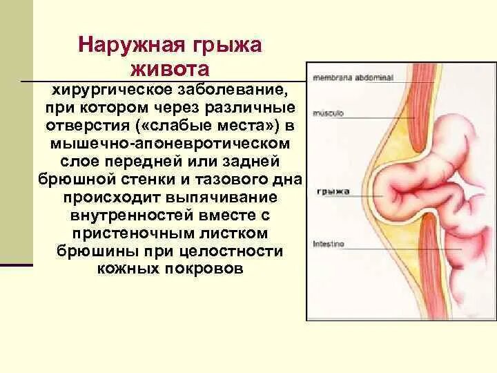 Наружные грыжи живота хирургические болезни. Классификация брюшных грыж. Классификация наружных грыж. Грыжа живота классификация.