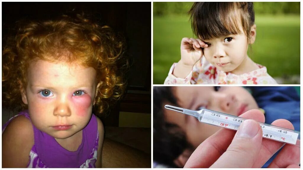 Mosquito Bite Images - Browse 2,665 Stock Photos, Vectors, and Video Adobe Stock
