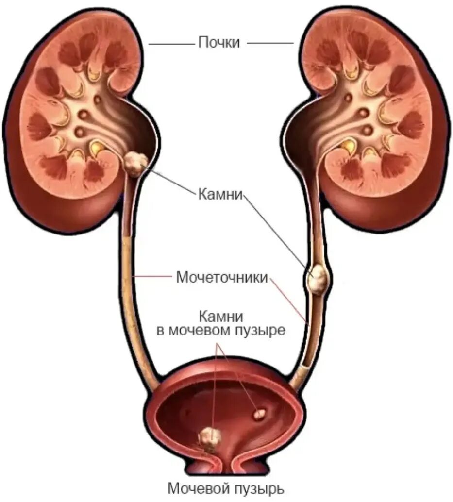 Строение мочеточника Устье мочеточника. Почки мочеточники мочевой пузырь. Мочекаменная болезнь камни в почках. Заболевания мочевыделительной системы мочекаменная болезнь. Почему лоханка