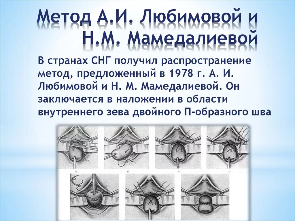 Шов по Любимовой на шейке матки. Шов на шейку матки по Любимовой. Метод Любимовой шов на шейку матки. Наложение швов по методики Любимовой. Швы при ицн