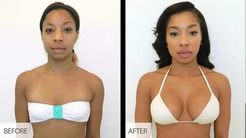 Before and After Breast Augmentation Surgery.