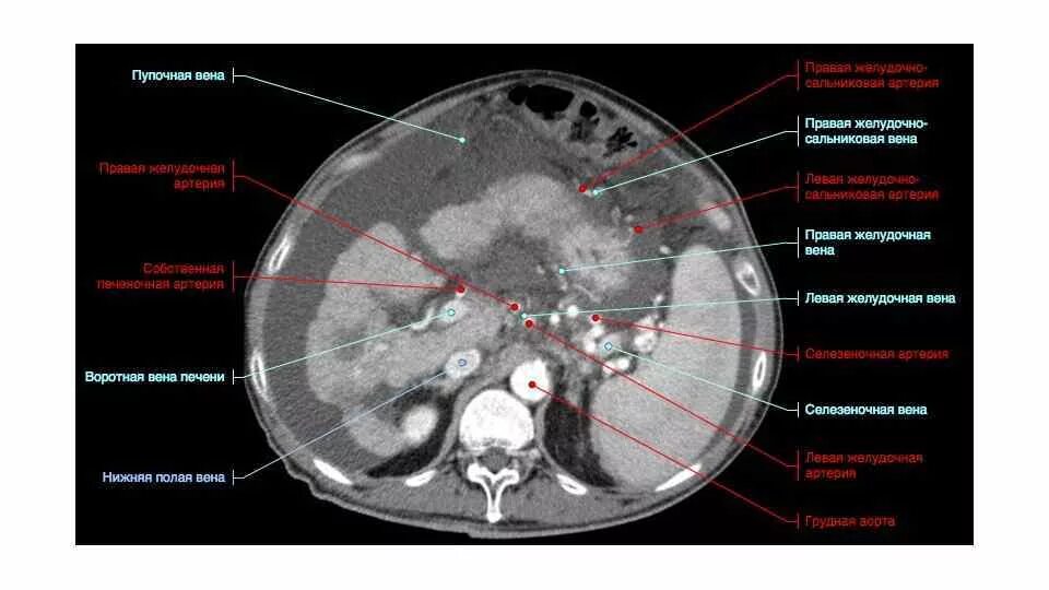 Расширение селезеночных вен. Кт брюшной полости фронтальный срез. Сосуды брюшной полости на кт. Анатомия артерий брюшной полости кт.