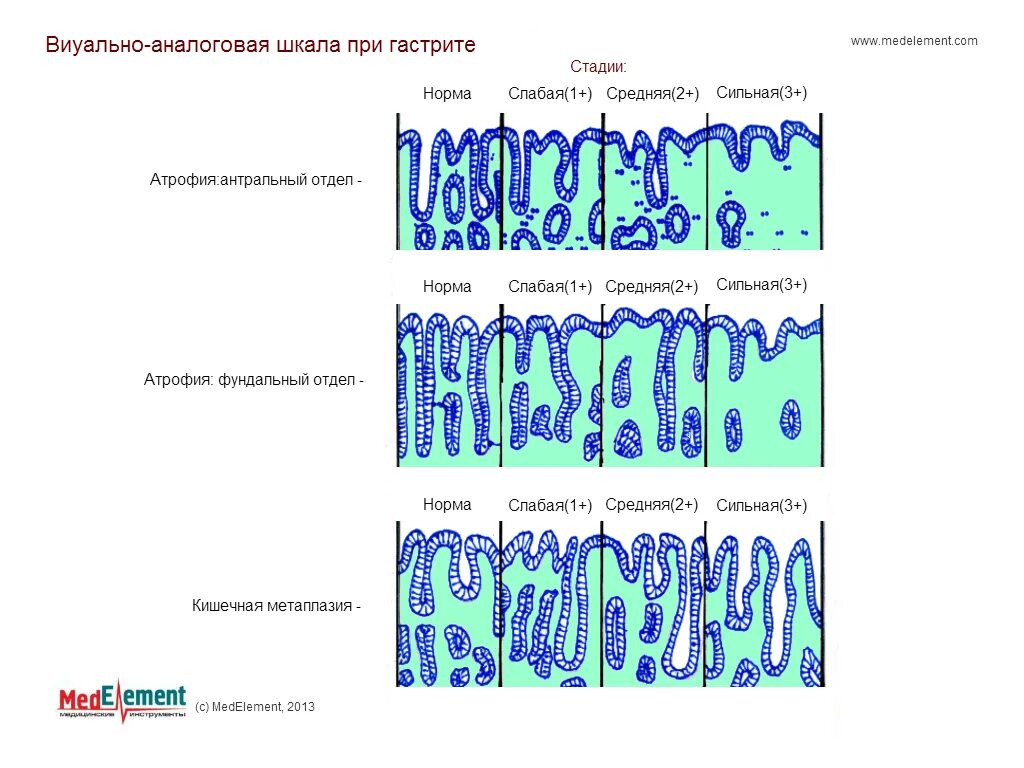 Гастрит 2 стадии. Кишечная метаплазия желудка гистология. Стадии атрофического гастрита. Визуально аналоговая шкала при гастрите. Классификация хронических гастритов по гистологии.