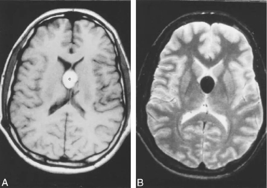 Киста головного мозга последствия. Colloid Cyst sellaris CT. Лакунарная киста 5 х 7 мм.