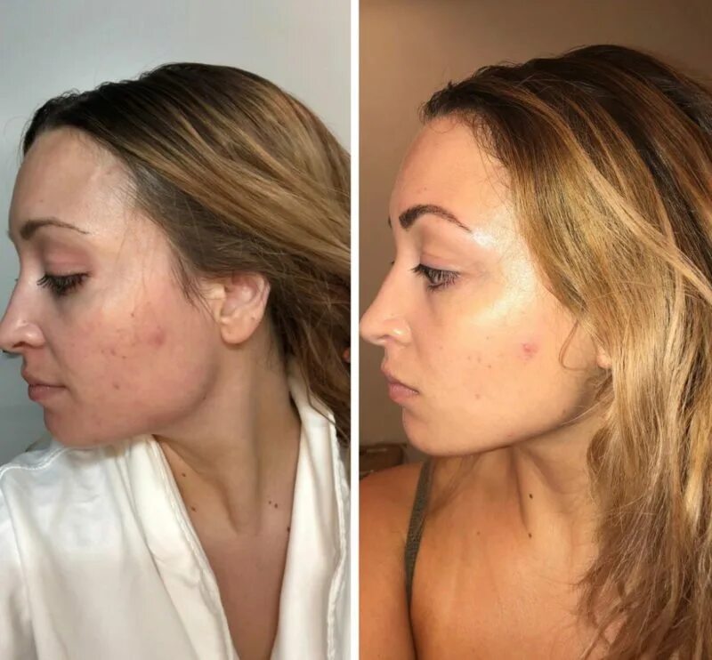 криомассаж отзывы