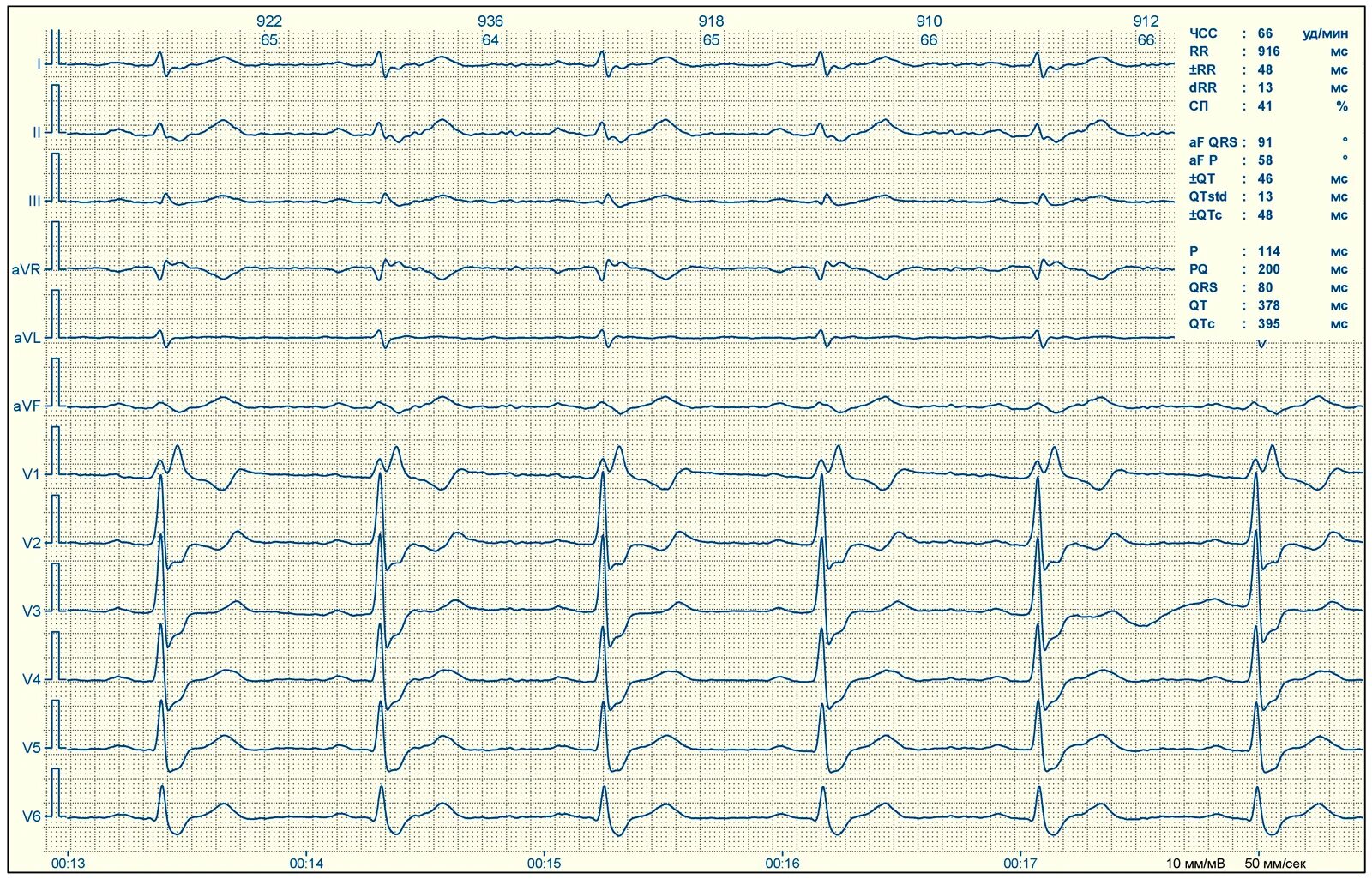 ЭКГ нормальные показатели ЭКГ. Нормальная диаграмма ЭКГ. Кардиограмма сердца расшифровка норма и патология. ЭКГ сердца примеры расшифровки. Тяжелое экг