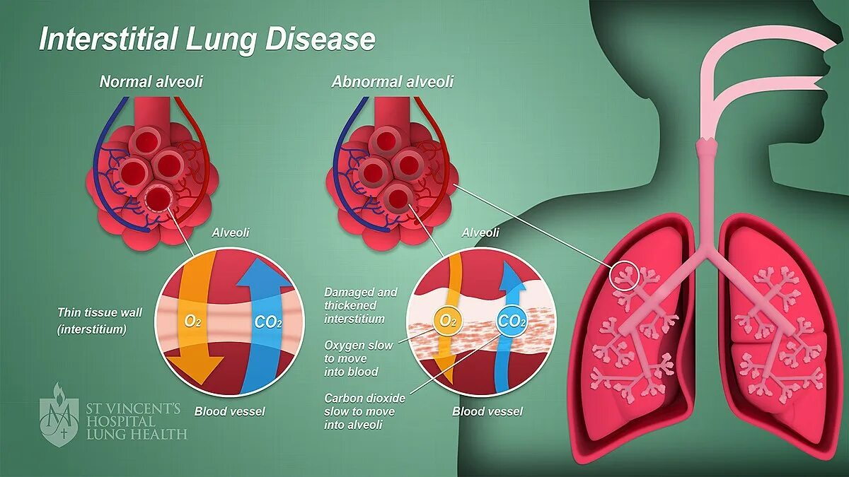 Lung disease. Дыхательная система человека. Lung disease. Lung disease. Lung disease.