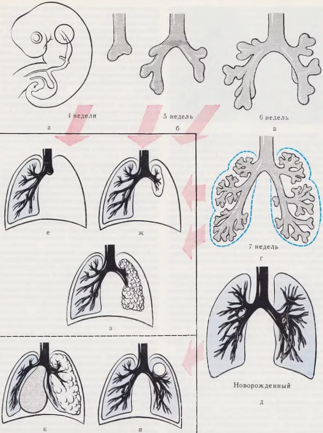 Стадии развития легких. Пороки развития легкого у детей. Легкие новорожденного ребенка. Пороки развития бронхов и легкого.