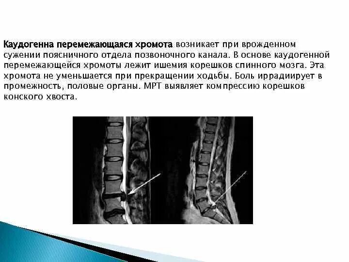 Перемежающая хромота основной признак. Перемежающаяся хромота спинного мозга. Врожденная узость позвоночного канала поясничного отдела. Каудогенная перемежающаяся хромота. Артерии поясничного отдела позвоночника.