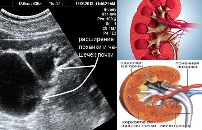 Что значит лоханка расширена. Внутрипочечная лоханка. Расширение почечной лоханки на УЗИ. Расширенная лоханка почки на УЗИ. Лоханка почки на УЗИ.