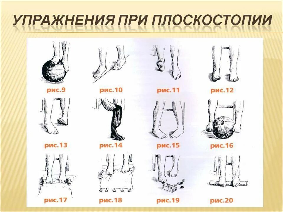 Комплекс упражнений для стопы. Упражнения для продольного плоскостопия 2 степени. ЛФК при продольном плоскостопии 2 степени. Гимнастика для продольного плоскостопия 2 степени. Упражнения от плоскостопия 2 степени у подростков.