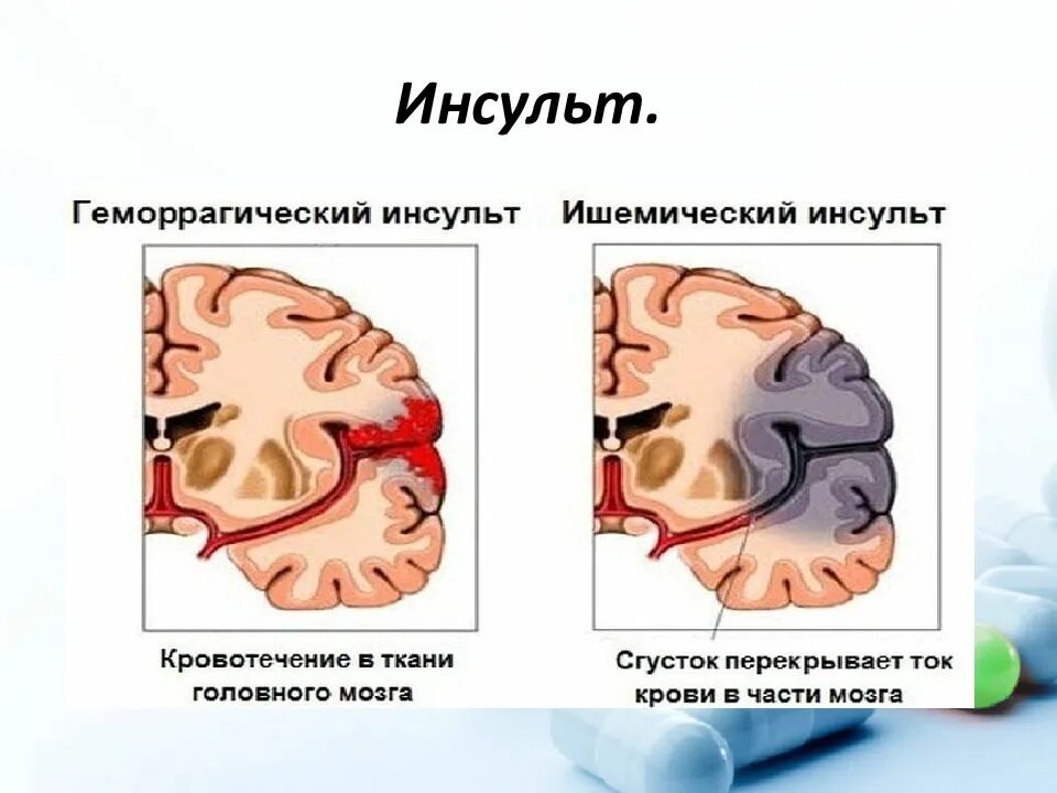 Может быть инсульт мозгов. ОНМК геморрагический инсульт симптомы. Патологическая анатомия ишемического инсульта. Исход ишемического инсульта головного мозга патанатомия.